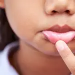 Le ulcere della bocca: i progressi degli studi su come curarle